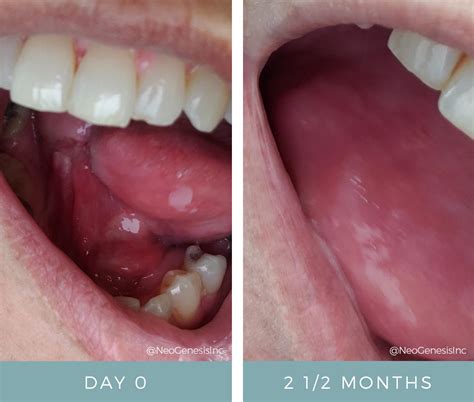 glossectomy vula|Partial Glossectomy for Tongue Cancer .